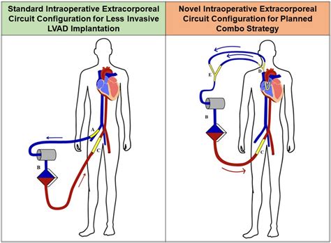 lvad vs ecmo